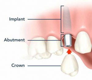 Ceo Erik Siegmund Explains What Makes Preferred Dental Technologies One 